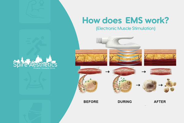EMS treatment for post pregnancy weight loss treatment Alcester