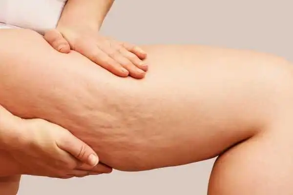 Image of woman showing leg with cellulite Alcester