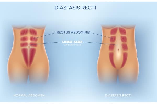 What Non-Surgical Options Are Available for Diastasis Recti Alcester?
