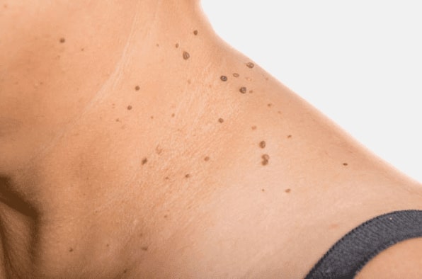Are you looking for easy skin tag removal Alcester - then contact Spire today!
