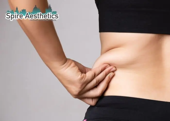 Image of woman pinching fat on their hips Alcester. Fat Freezing treatment
