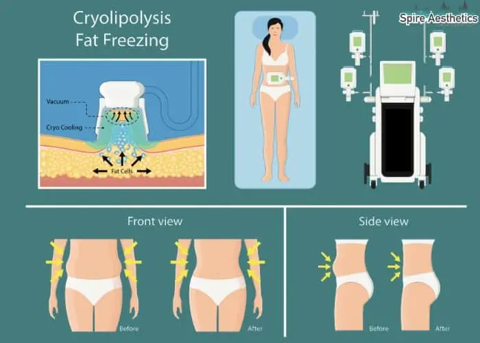 Fat freezing treatment Alcester benefits for competitions to remove stubborn fat deposits.