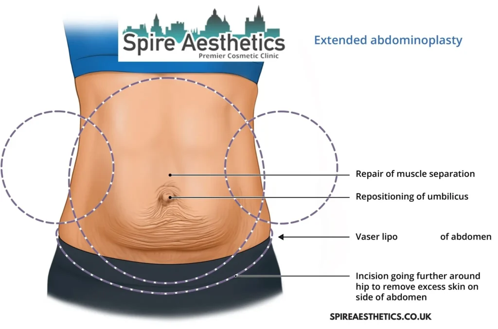 Understanding Loose Skin After Gastric Band Alcester Surgery and HIFU Treatment 