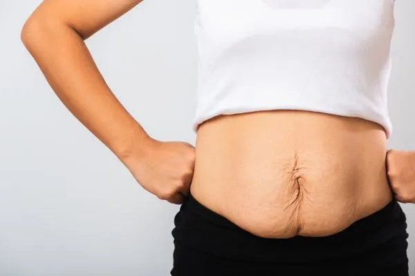 Image of a woman's stomach after weight loss with sagging skin following a gastric band Alcester