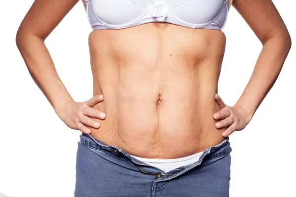 sagging skin on woman's stomach after weight loss injections Alcester