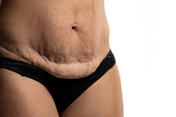 Image of womans stomach after weight loss injections Alcester showing saggy skin