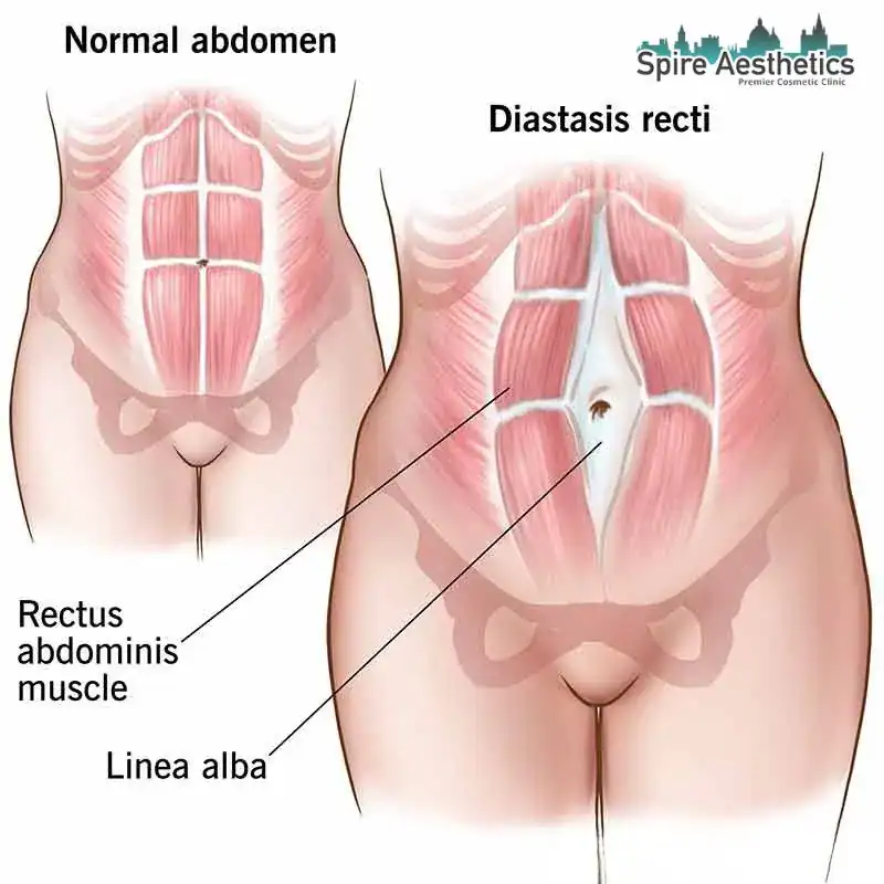 When Will My Belly Feel Normal Again Alcester?
