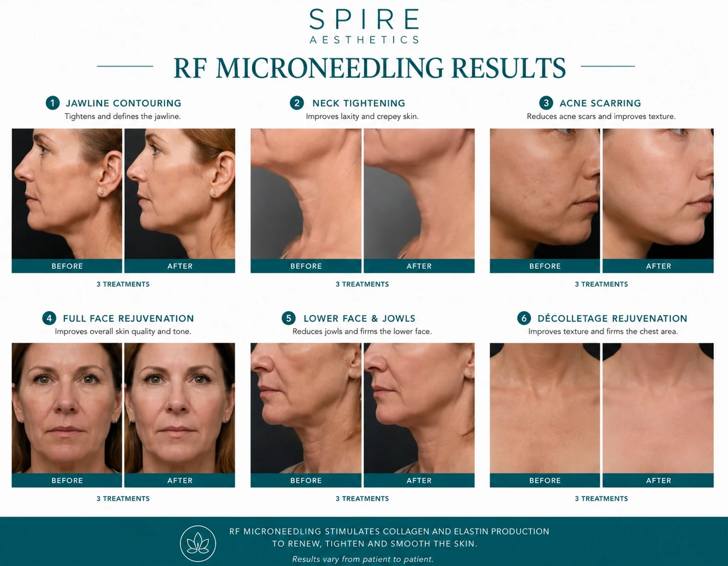 RF Microneedling Skin tightening Alcester results