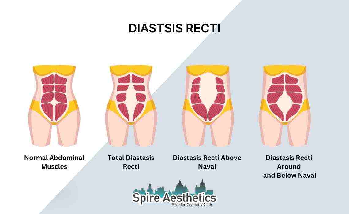 Is Non-Surgical Diastasis Recti Treatment Right for You? Common Concerns Answered Alcester